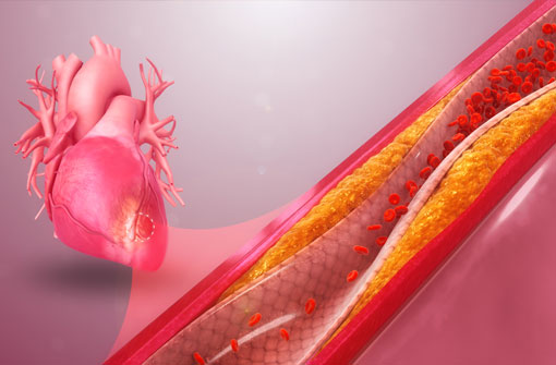 Coronary Artery Disease